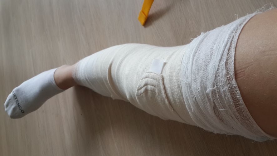 Гипс коленный сустав Гипс коленный сустав