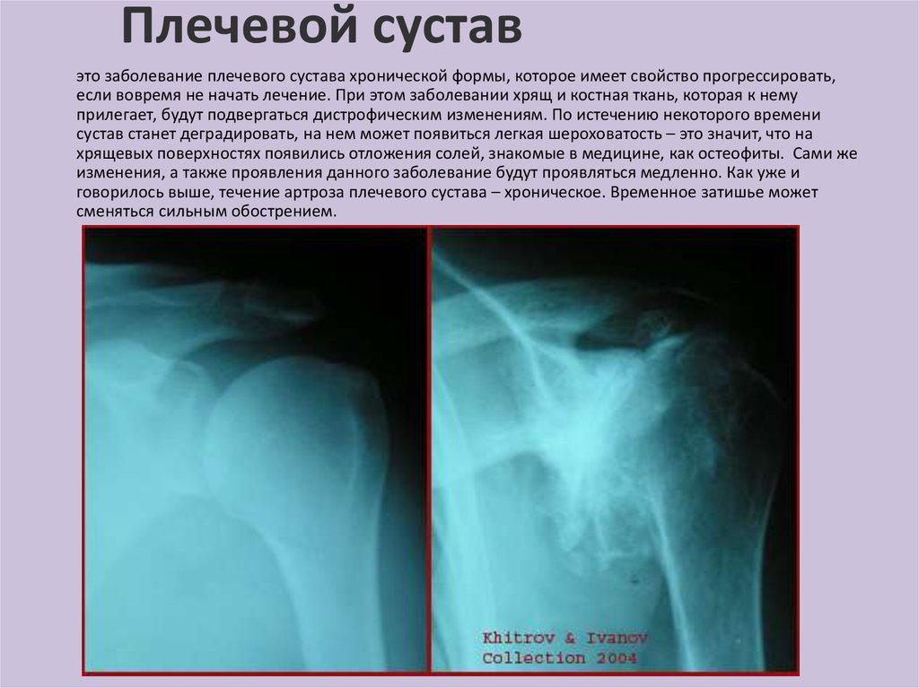 Деформирующий артроз коленного сустава: причины, симптомы, методы Деформирующий артроз коленного сустава, что это такое и как вылечить?