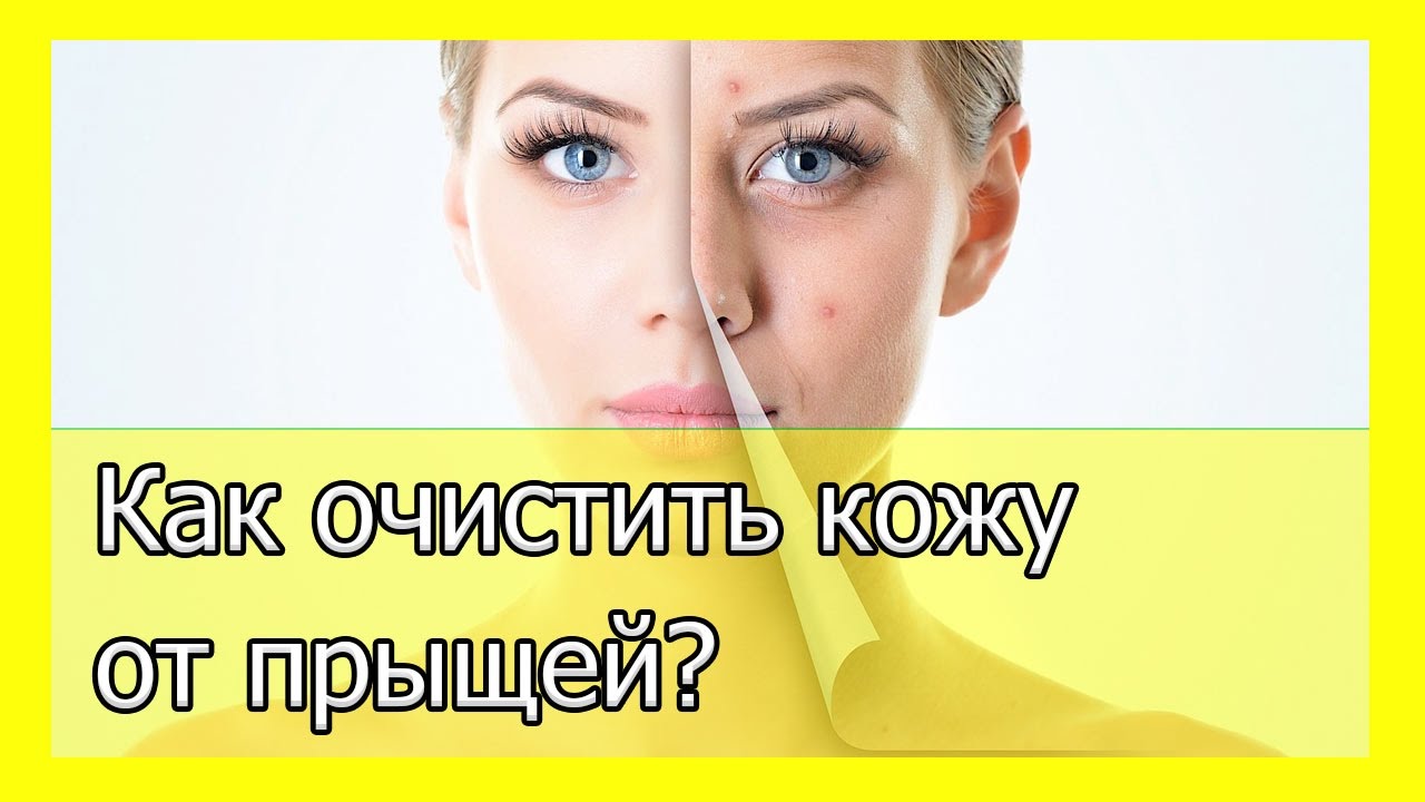 Как почистить кожу на лице от прыщей Как почистить кожу на лице от прыщей