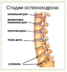 Хронический остеохондроз поясничного отдела лечение Хронический остеохондроз поясничного отдела лечение