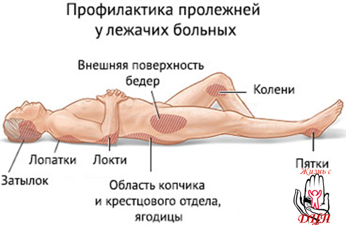 Лечение пародонтоза в домашних условиях Компетентно о Лечение глистов народными средствами