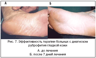 Микозы стоп грибок ногтей и кожи стопы