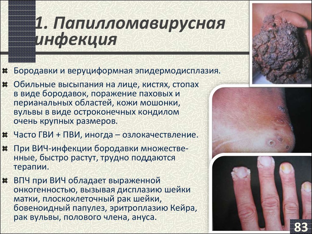 Проявление на коже или вич Проявление на коже или вич
