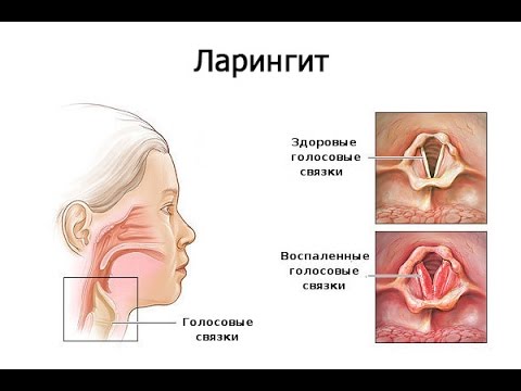 Что такое острый фарингит и как его лечить Что такое острый фарингит и как его лечить