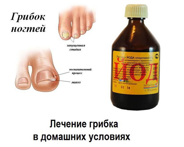 Как вылечит грибок стопы в домашних условиях