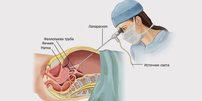 Противопоказания к лапароскопии в гинекологии