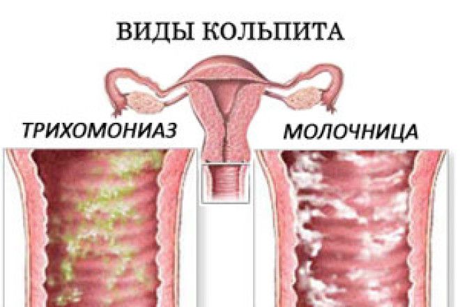 Женские болезни гинекология зуд вульвит
