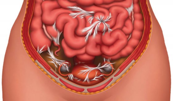 Жидкость в брюшной полости в гинекологии
