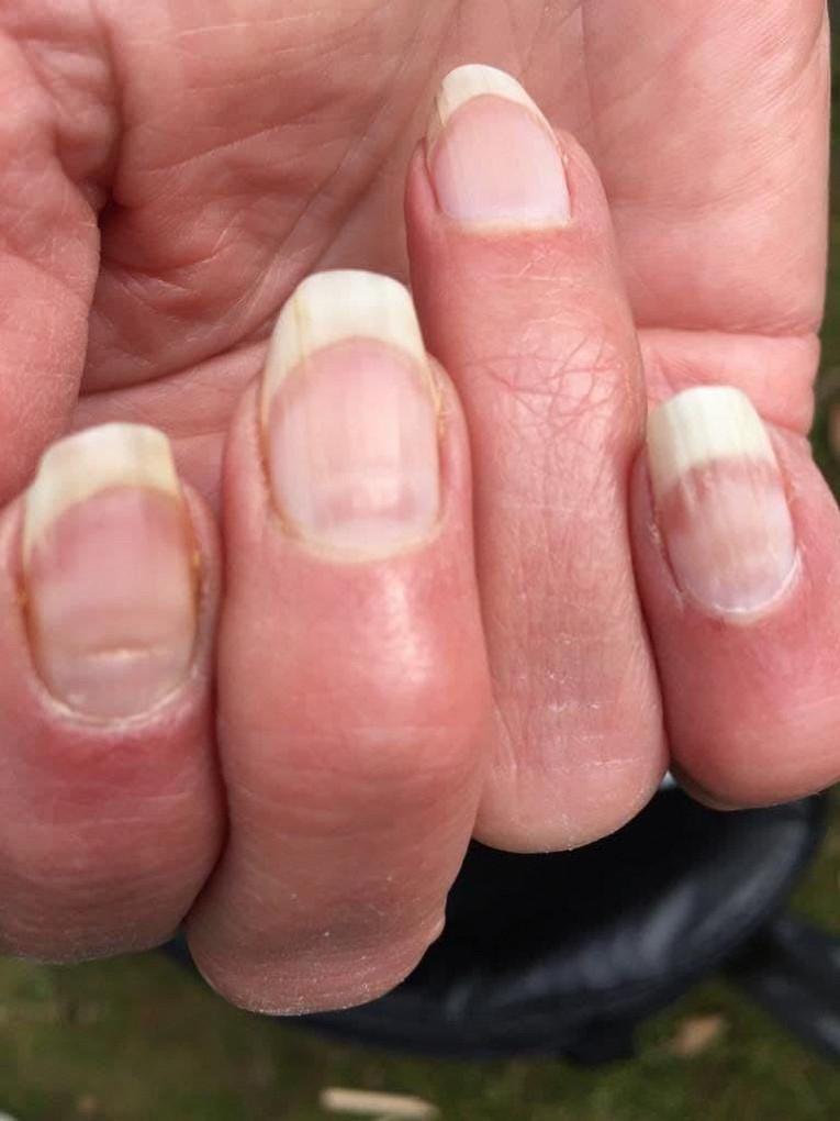 This Father of Two Nearly Died of Sepsis After Biting His Nails Sepsis, Nail bit